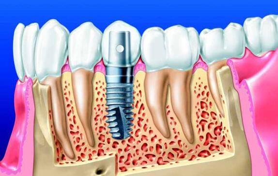 最新牙种植技术引领牙科领域革新风潮